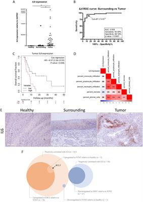 IL6 and BCL3 Expression Are Potential Biomarkers in Esophageal Squamous Cell Carcinoma